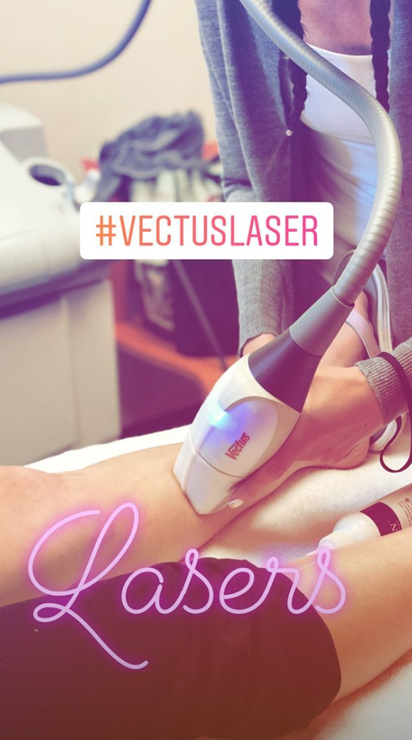 Hair Removal with the Palomar Vectus Laser